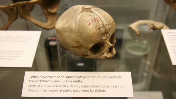 Lebka novorozence (foto: NM) foto: lebka novorozence se smrtelným poraněním po průchodu křivicí deformovanou pánví matky
